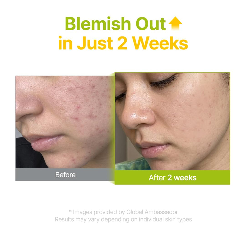 PURITO Ácido Azelaico 10% + Ácido Kójico + Suero Facial de Árbol de Té | para Acné y Marcas, Brotes